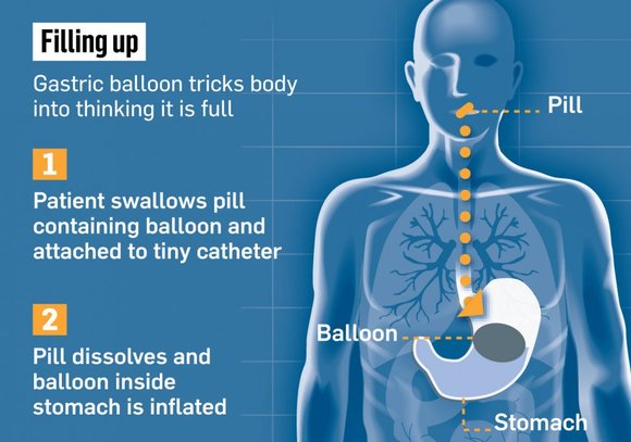 Weight Loss Balloon Pill >> This Balloon Pill Will Leave You Speechless Weight Loss Balloon Pill >> This Balloon Pill Will Leave You Speechless