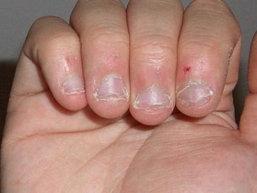 7 Effective Ways To Stop Biting Your Nails Parhlo Nail Biting