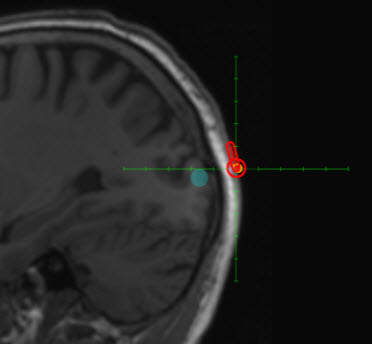 MRI image showing location of TMS phosphene generator (credit: Carles Grau et al./PLoS ONE)