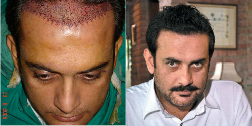 Here are 10 Pakistani Celebrities who got a Hair Transplant and it changed  their Lives for Good