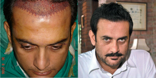 Here are 10 Pakistani Celebrities who got a Hair Transplant and it changed their Lives for Good Here are 10 Pakistani Celebrities who got a Hair Transplant and it changed their Lives for Good