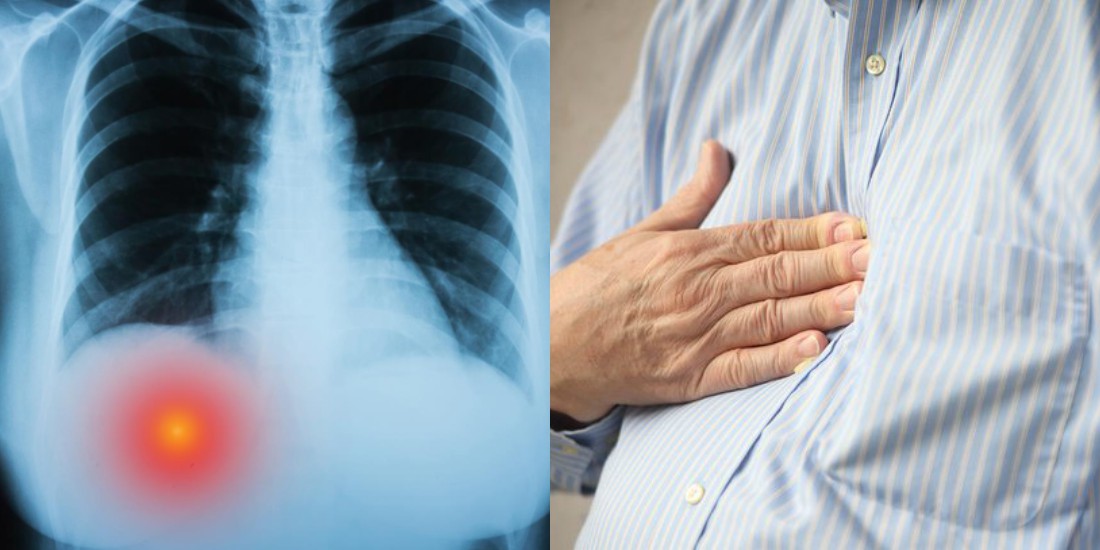 Can Gerd Cause Pain Under Rib Cage