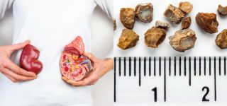 kidney stone diet chart