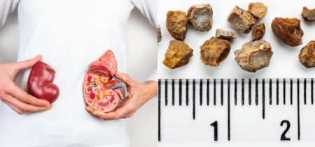 kidney stone diet chart