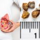 kidney stone diet chart