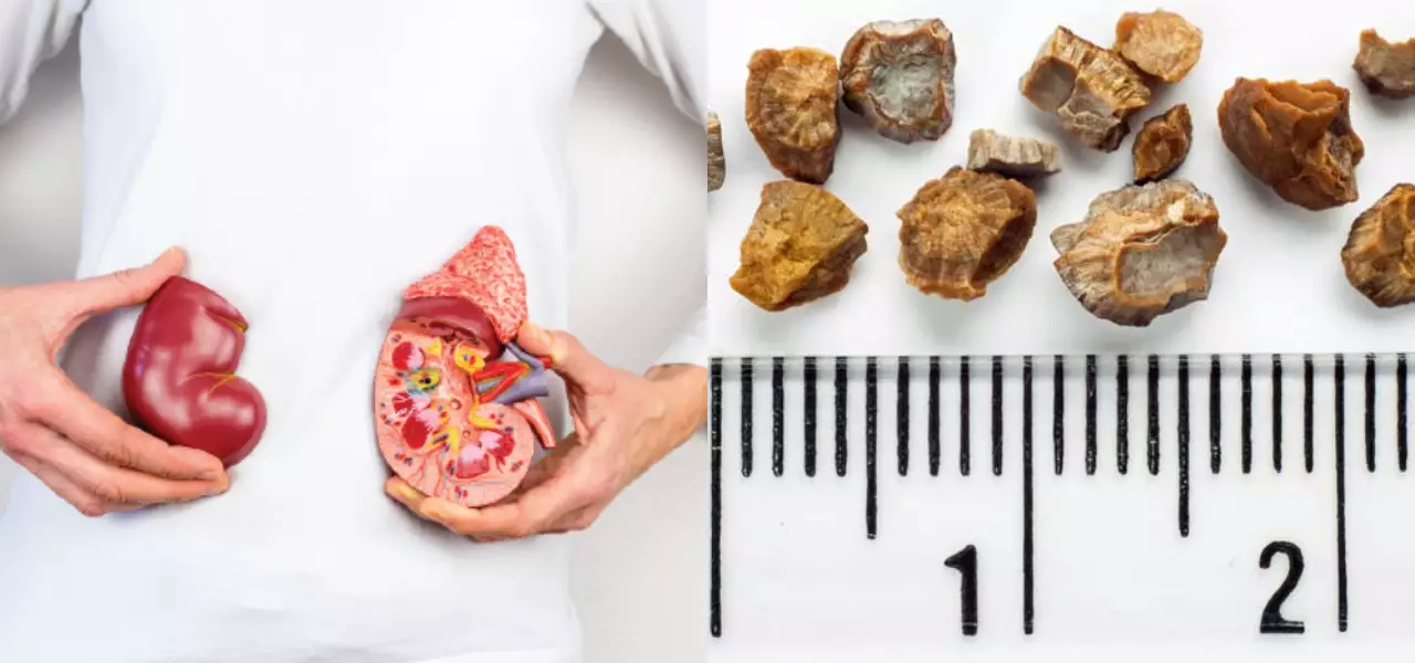 Kidney Stone Patient Food Chart