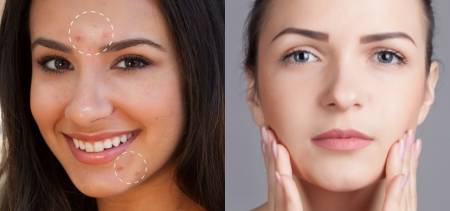 get rid of acne