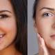 get rid of acne