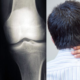 World Osteoporosis Day