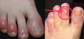 covid toe