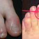covid toe