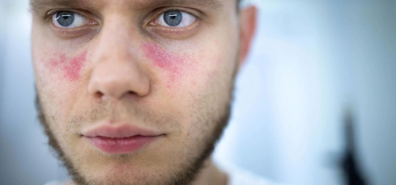 Lupus Disease New Research reveals insights into the Root Cause