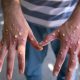 MPox On The Rise, Airport Authority Adopts New Protocols