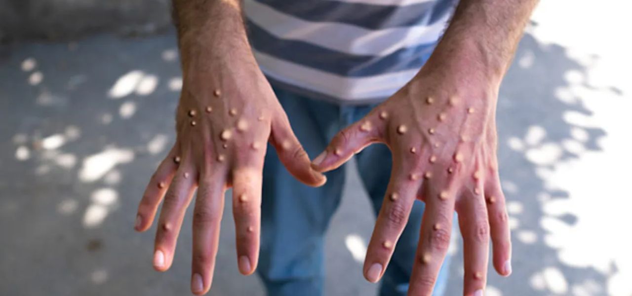 MPox On The Rise, Airport Authority Adopts New Protocols Parhlo