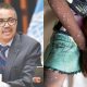 WHO Declares MPox International Health Emergency, NCOC Meeting Called